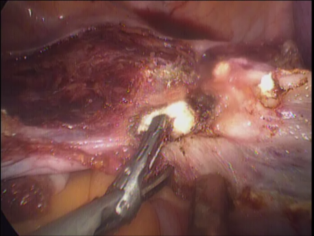 laparoscopic hysterectomy - 9 cutting the parametrium