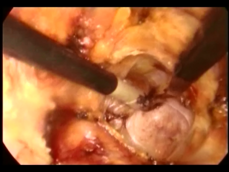 prolapse - 1 - exposing the anterior longitudinal ligament over the saccral bone
