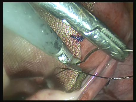 prolapse - 11 - mesh also fixed to the posterior aspect of the cervix