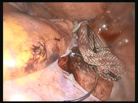 prolapse - 12 - mesh fixed to the anterior longitudinal ligament over the sacrum to pull up the uterus