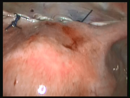 prolapse - 13 - final picture after shortening the round ligaments and closure of the bladder peritoneum