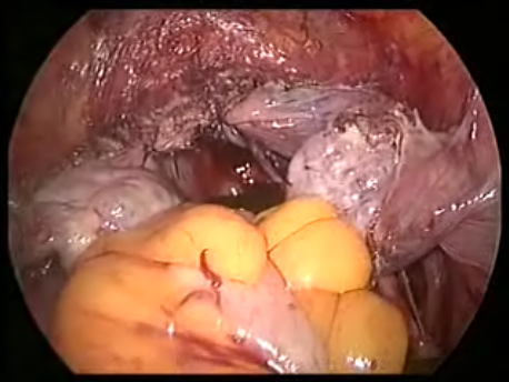 prolapse - 14 - uterosacral ligament plication