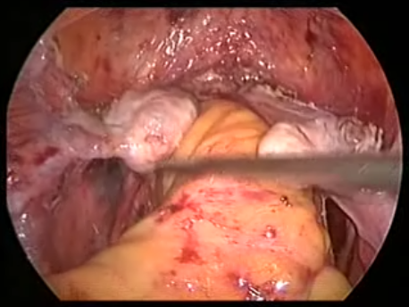 prolapse - 15 - obliteration of the pouch of Douglas culdoplasty