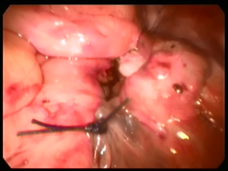 prolapse - 6 - final picture of the buried mesh anchoring the vagina to the sacrum