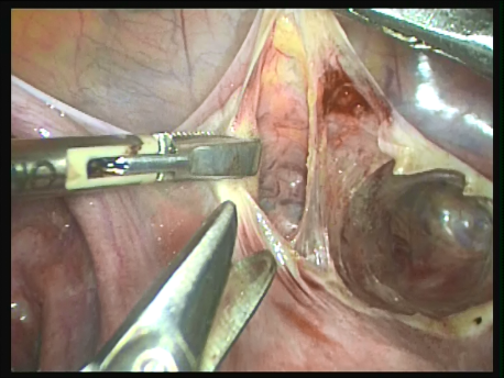 prolapse - 7 - dissecting the bladder away from the cervix in an intact uterus