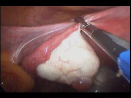 single port laparoscopic surgery - 1 - single port laparoscopic hysterectomy