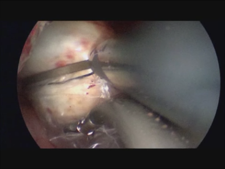 single port laparoscopic surgery - 10 - removal of cyst through single port
