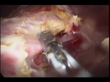 single port laparoscopic surgery - 2 - sealing of uterine vessels in single incision hysterectomy