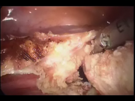 single port laparoscopic surgery - 3 - opening the vagina in single incision hysterectomy