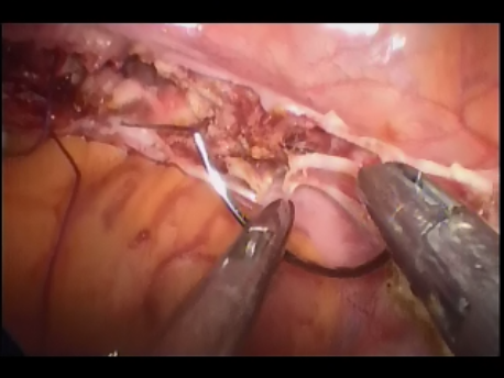 single port laparoscopic surgery - 4 - suturing of vagina