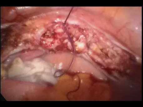 single port laparoscopic surgery - 5 - final view after single incision hysteretomy