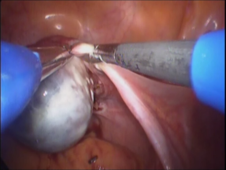 single port laparoscopic surgery - 6 - single incision oophorectomy