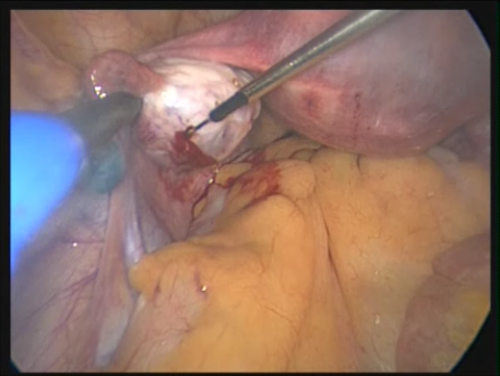 single port laparoscopic surgery - 8 - ovarian drilling with 2 3mm instrument