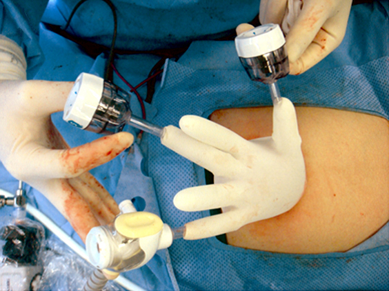 single port laparoscopic surgery - instruments - glove port