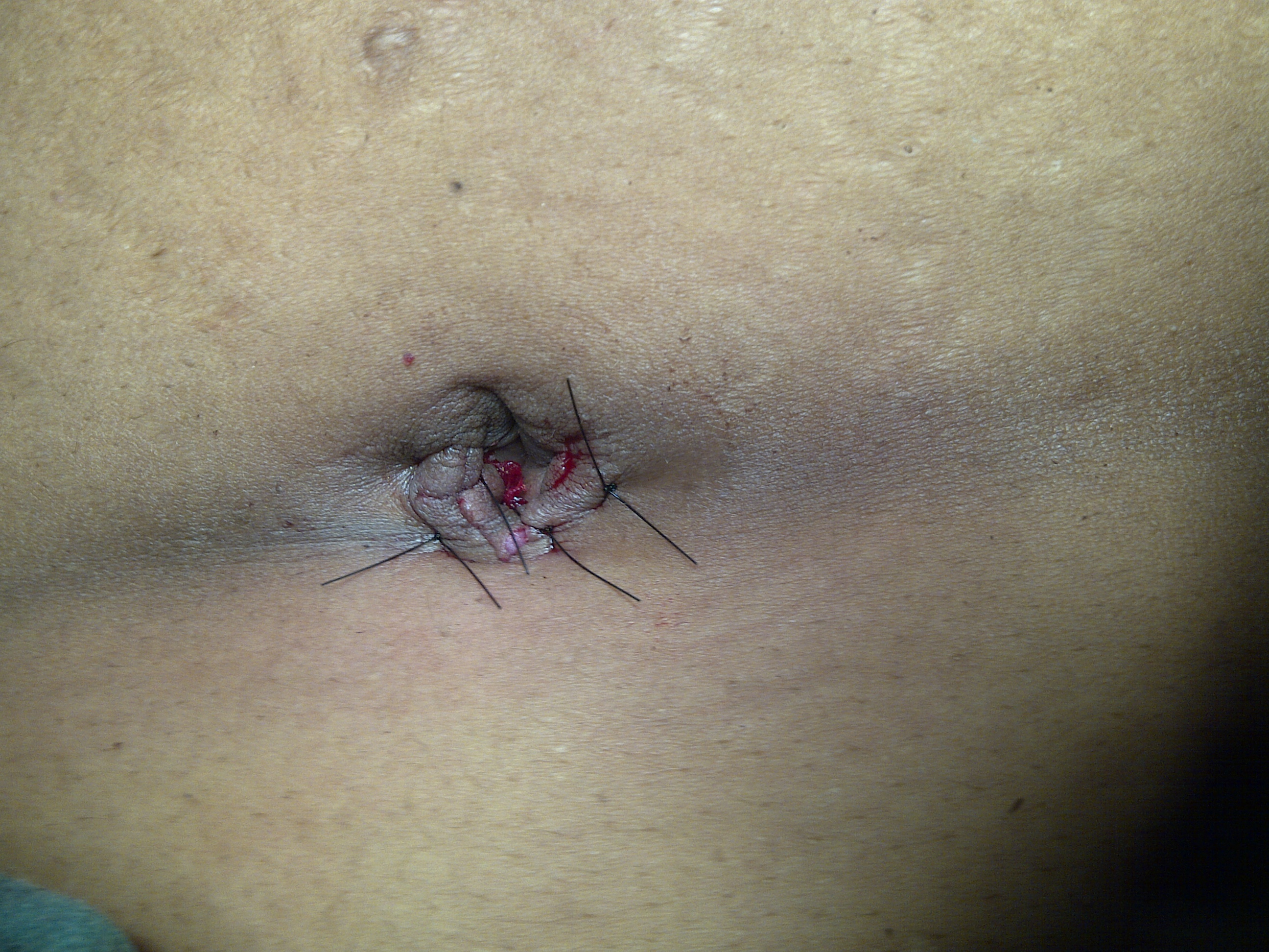 single port laparoscopic surgery - instruments - single port scar