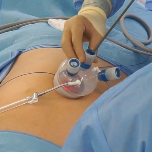 Single Port Laparoscopic Surgery