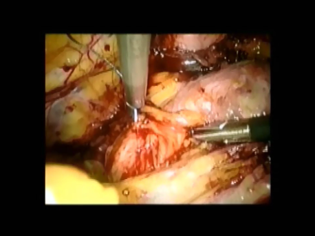 urinary incontinence - 11 - Burch colopsuspension fixing the suture to the paravaginal fascia