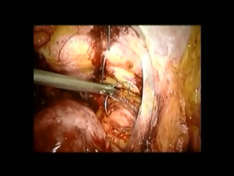 urinary incontinence - 12 - Burch colposuspension taking additional sutures