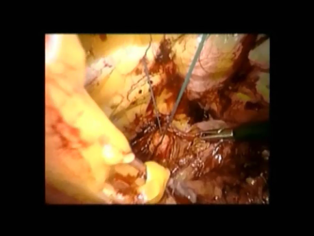 urinary incontinence - 13 - Adjusting tension on the sutures