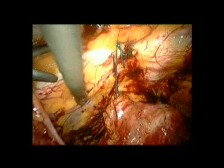 urinary incontinence - 14 - sutures tied and cut