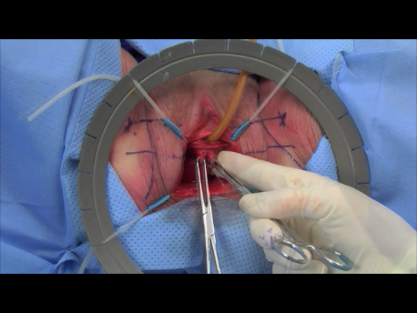 urinary incontinence - 2 - Incision on the anterior vaginal wall