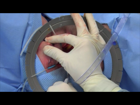 urinary incontinence - 3 - passing the TVT needle through the vagina