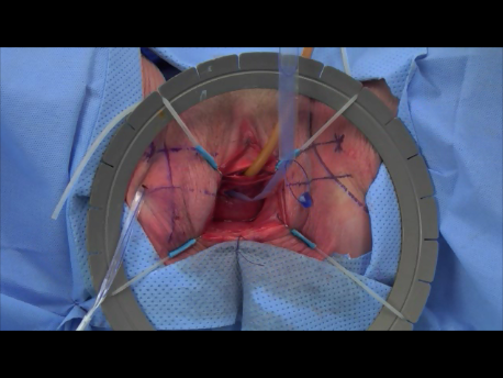 urinary incontinence - 5 - tape brought out through the skin and needle removed