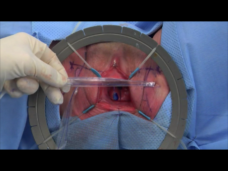 urinary incontinence - 6 - plastic cover of the TVT tape being removed