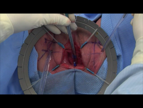 urinary incontinence - 7 - adjusting the tension on the mesh