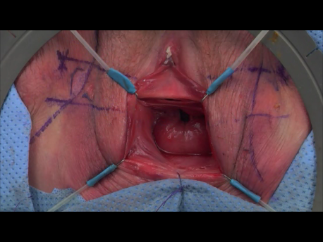 urinary incontinence - 8 - excess tape cut and vagina sutured