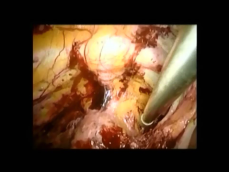 urinary incontinence - 9 - Burch colposuspension dissecting the space of Retzius