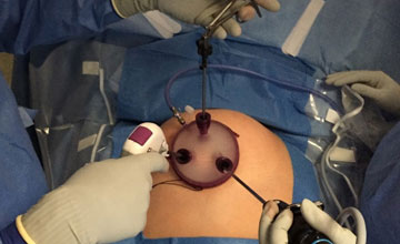 single port laparoscopic surgery